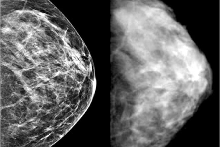 Маммография фкм. Маммография фиброзно кистозная мастопатия снимки. Кистозная мастопатия маммография. Узловая мастопатия молочной железы маммография. Кистозно фиброзная мастопатия на маммографии.
