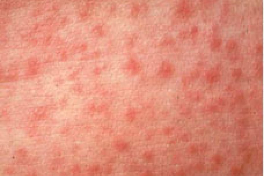 Example of the rash caused by measles